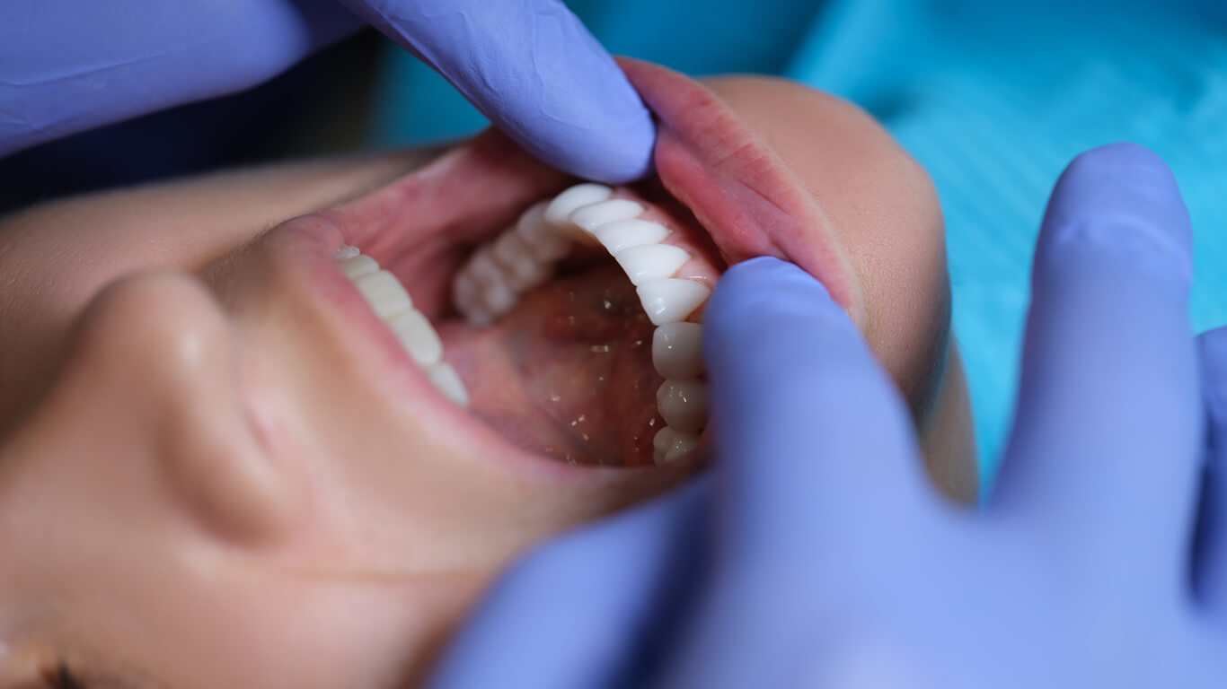 what are veneers